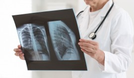 Эффективность лечения впервые выявленного туберкулёза в Чеченской Республике достигла 90%